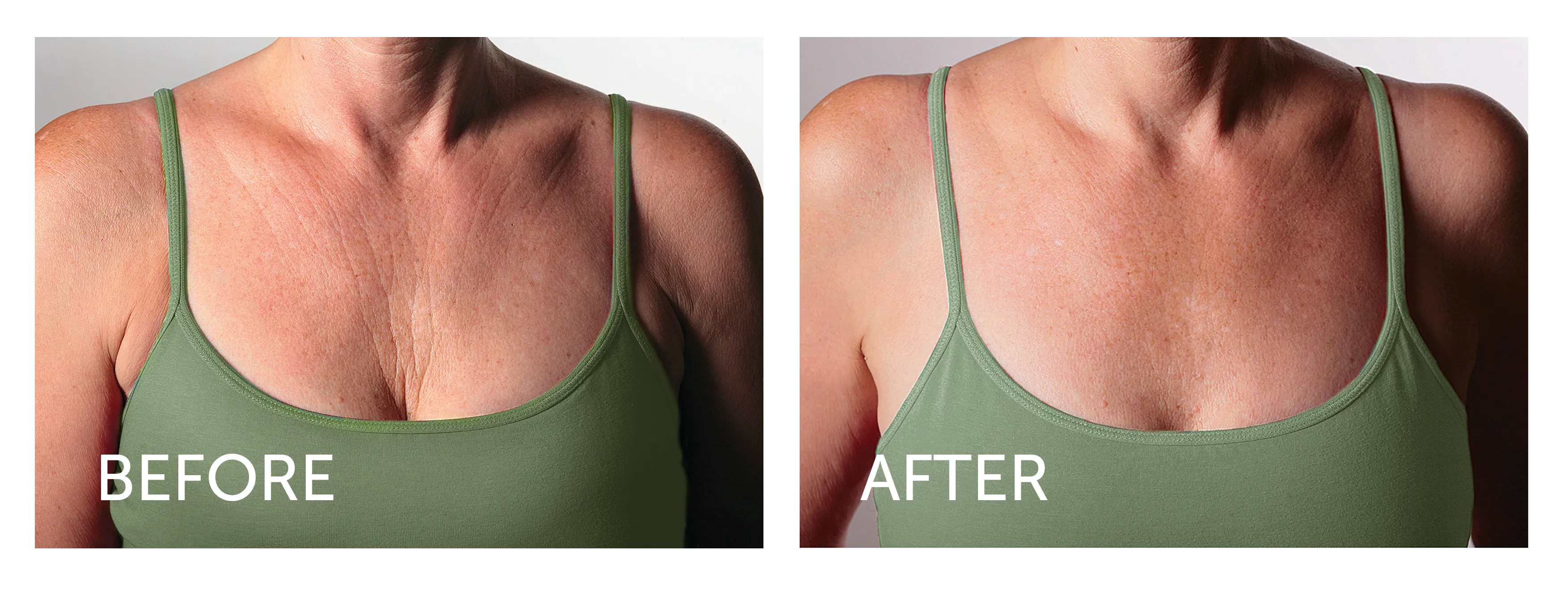 Silc Skin Decollette Pad - Correct & Prevent Chest Wrinkles, 1 pad, (Calvet Cosmetics)